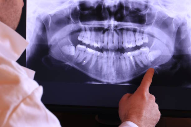 Best Emergency Tooth Extraction in Cobden, IL